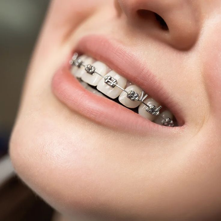 Professional orthodontic braces treatment